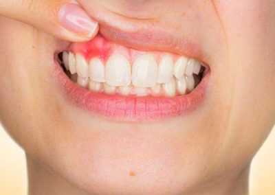 Cáncer Oral