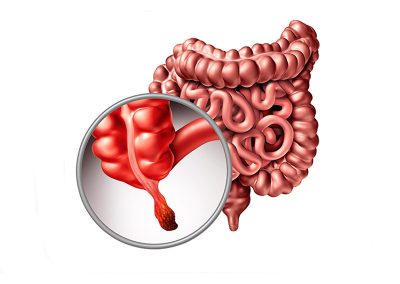 ¿Qué es la apendicitis?