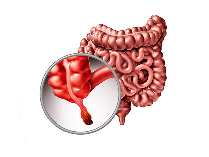 ¿Qué es la apendicitis?