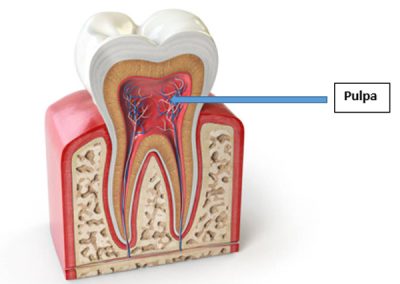 Qué cuidados debemos tener después de una endodoncia