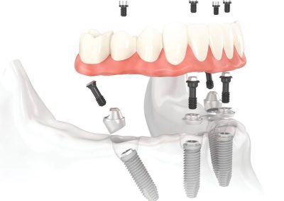 Rehabilitación Oral sobre Implantes