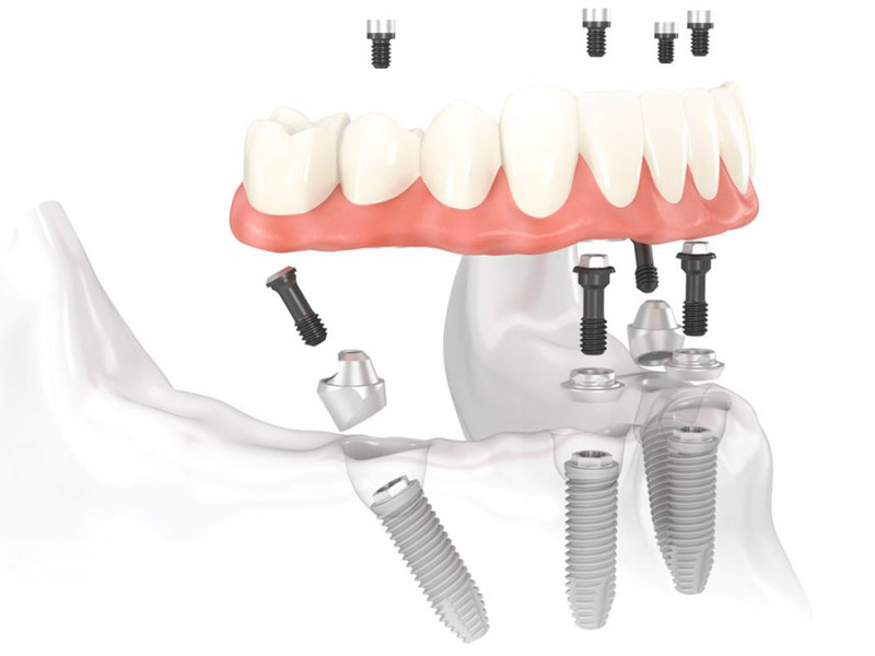 Rehabilitación Oral sobre Implantes