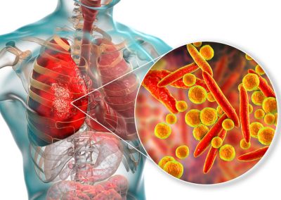Mycoplasma pneumoniae