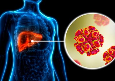 28 de julio: Día Mundial contra la Hepatitis