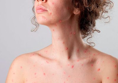 Cómo prevenir el contagio de varicela