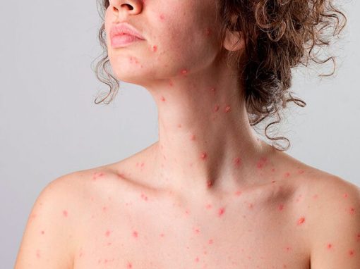 Cómo prevenir el contagio de varicela